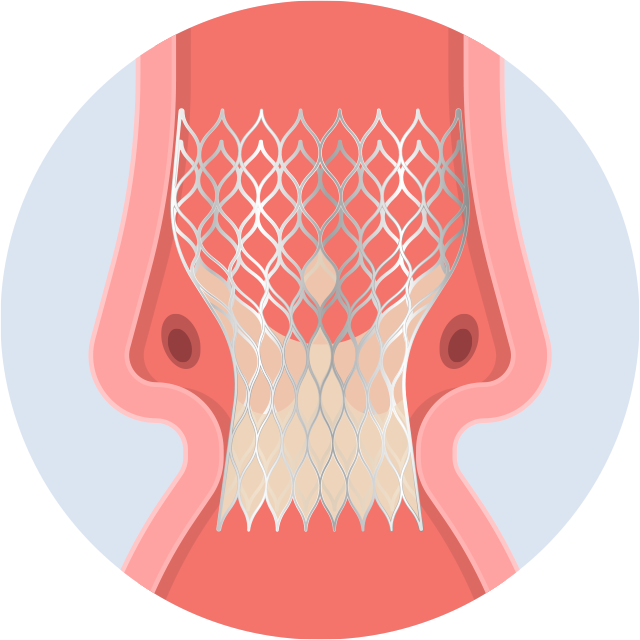 Esempio di protesi valvolare transcatetere rilasciata in posizione aortica