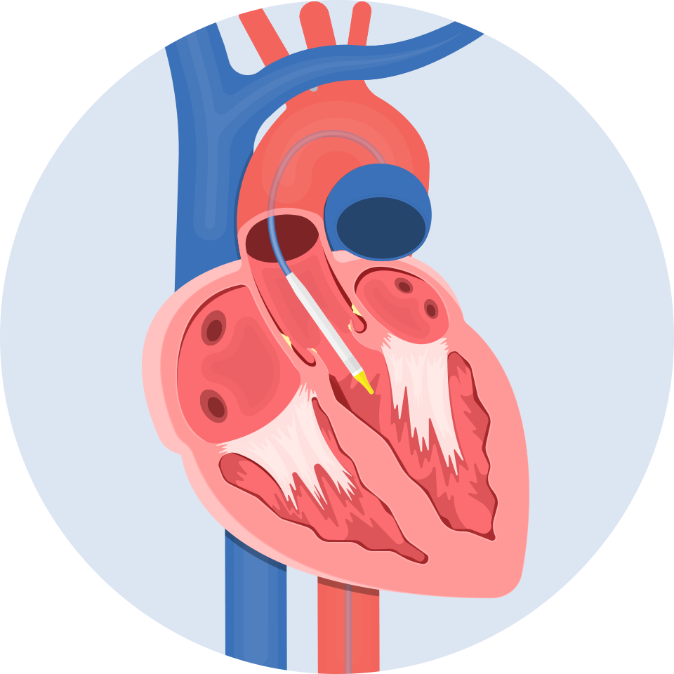 Il sistema di rilascio della protesi valvolare è inserito attraverso l'aorta